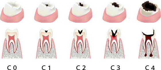 C0-C4.jpg